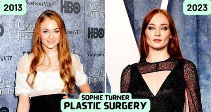 
Did Sophie Turner Get Plastic Surgery? Who is Sophie Turner? 