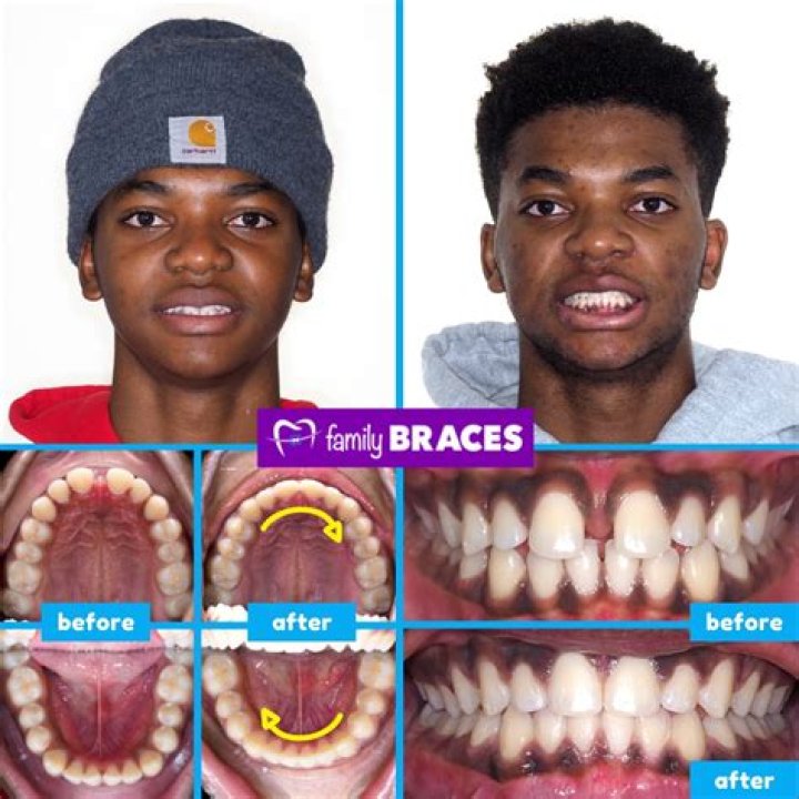 Justin Swanstrom Teeth Before And After Photos, Has He Used Braces Costing $20K?